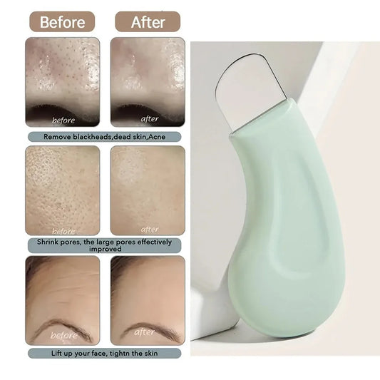 Blackhead & Whitehead Removal Tool – Rankinis porų valiklis