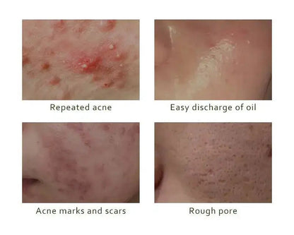 BELYN BERLY – Brighten & Acne Clear serumų rinkinys